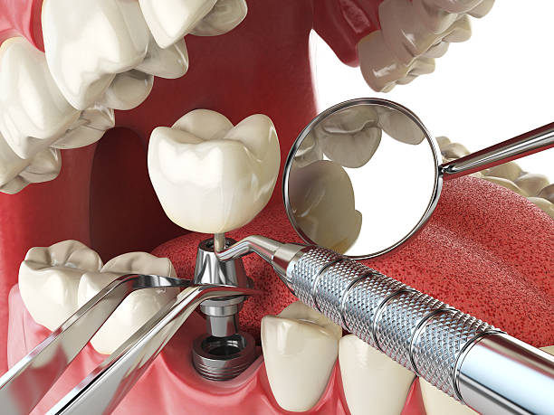Best Emergency Dental Care for Broken or Chipped Teeth in Chalfont, PA